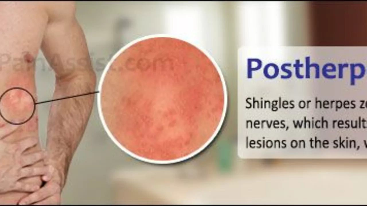Skin Pain And Shingles Causes Symptoms And Treatment